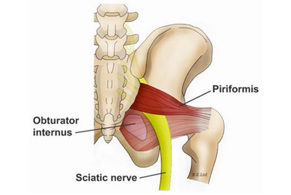 Piriformis syndrome