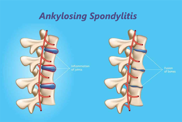 Ankylosing Spondylitis