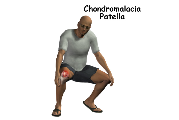 Chondromalacia Patella