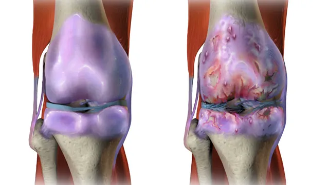 Best Osteoarthritis Physiotherapy Treatment