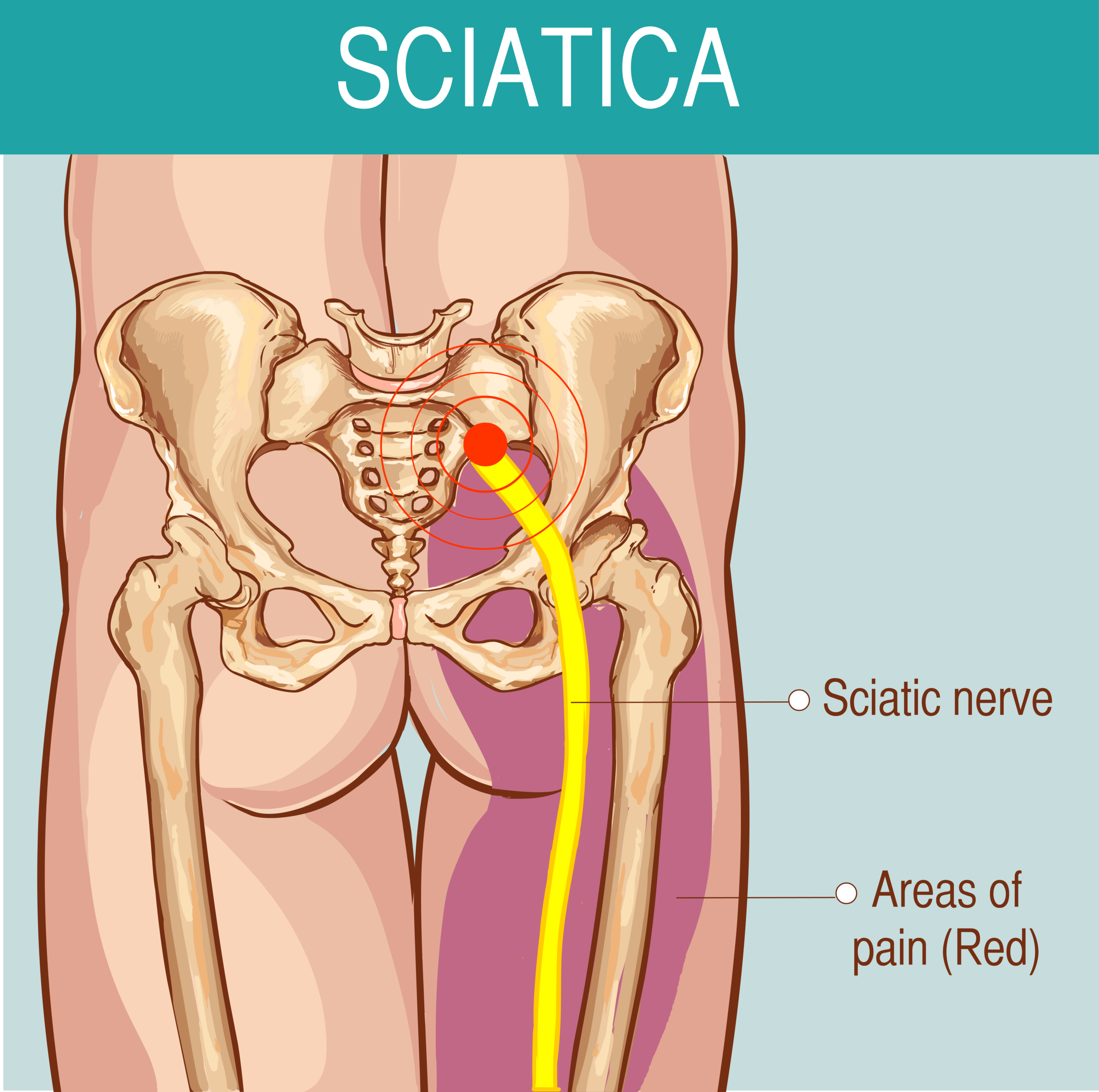 Sciatica Pain Physiotherapy