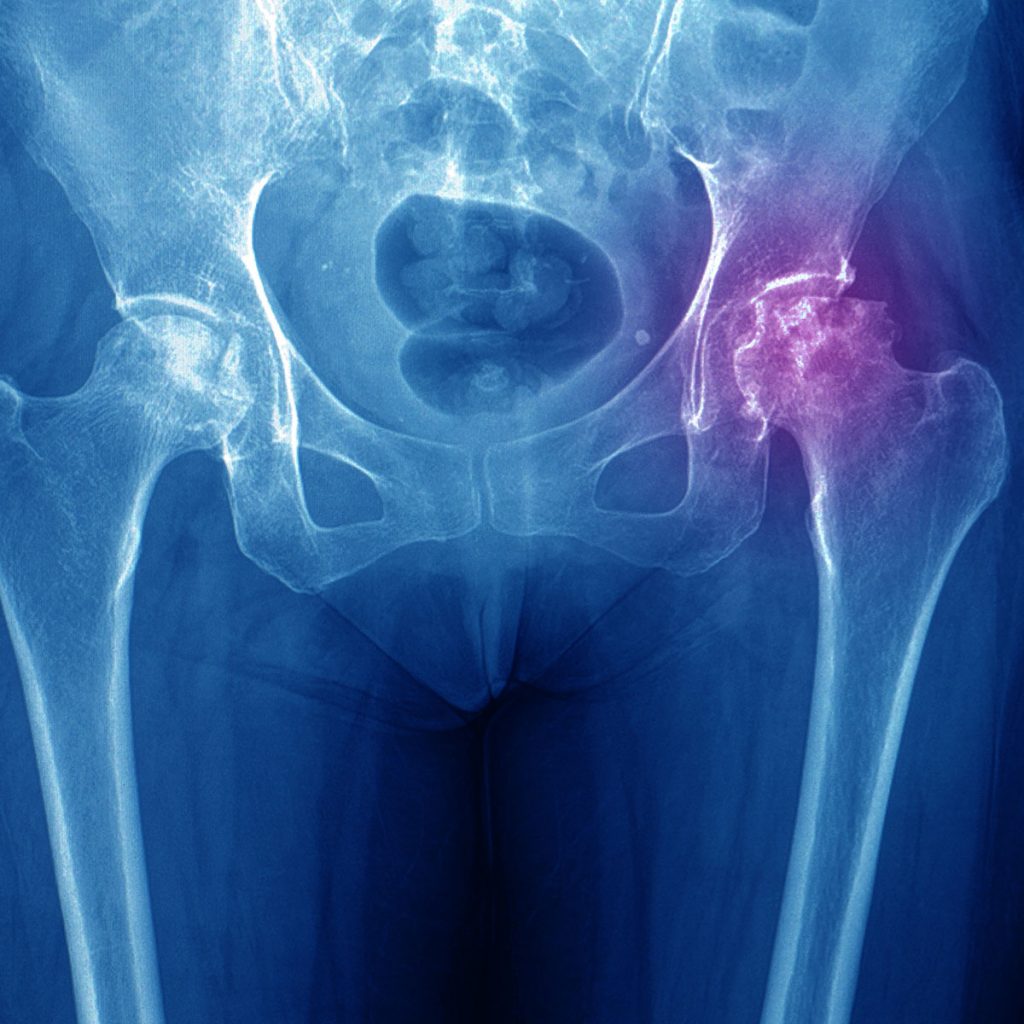 Avascular Necrosis Treatment