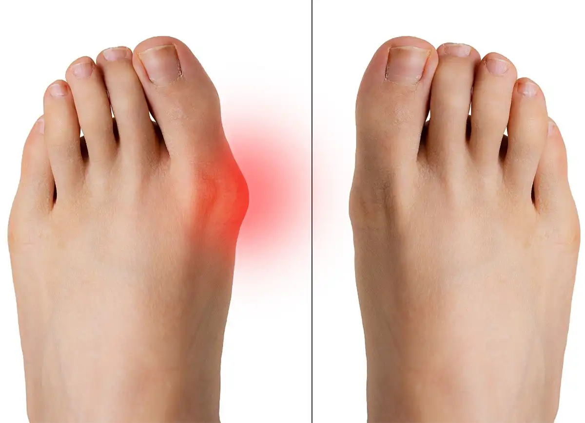 Hallux Valgus Treatment